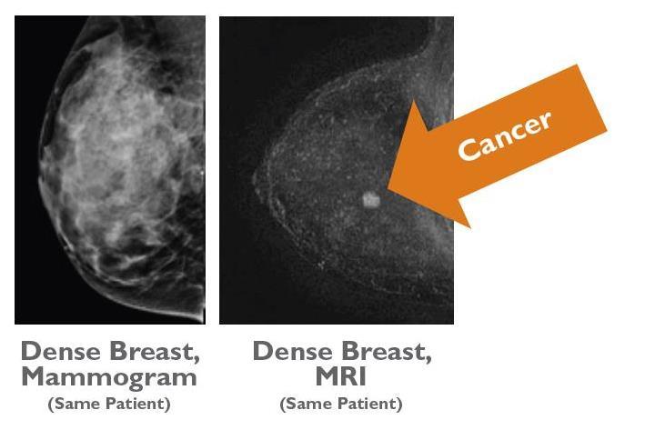 Dense Breast Mr Protocol Showing Promise At Seattle Radiology Center