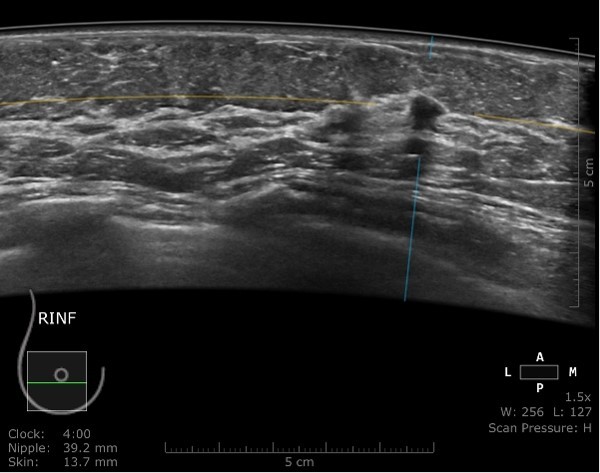 dense-breast-tissue-and-automated-breast-ultrasound