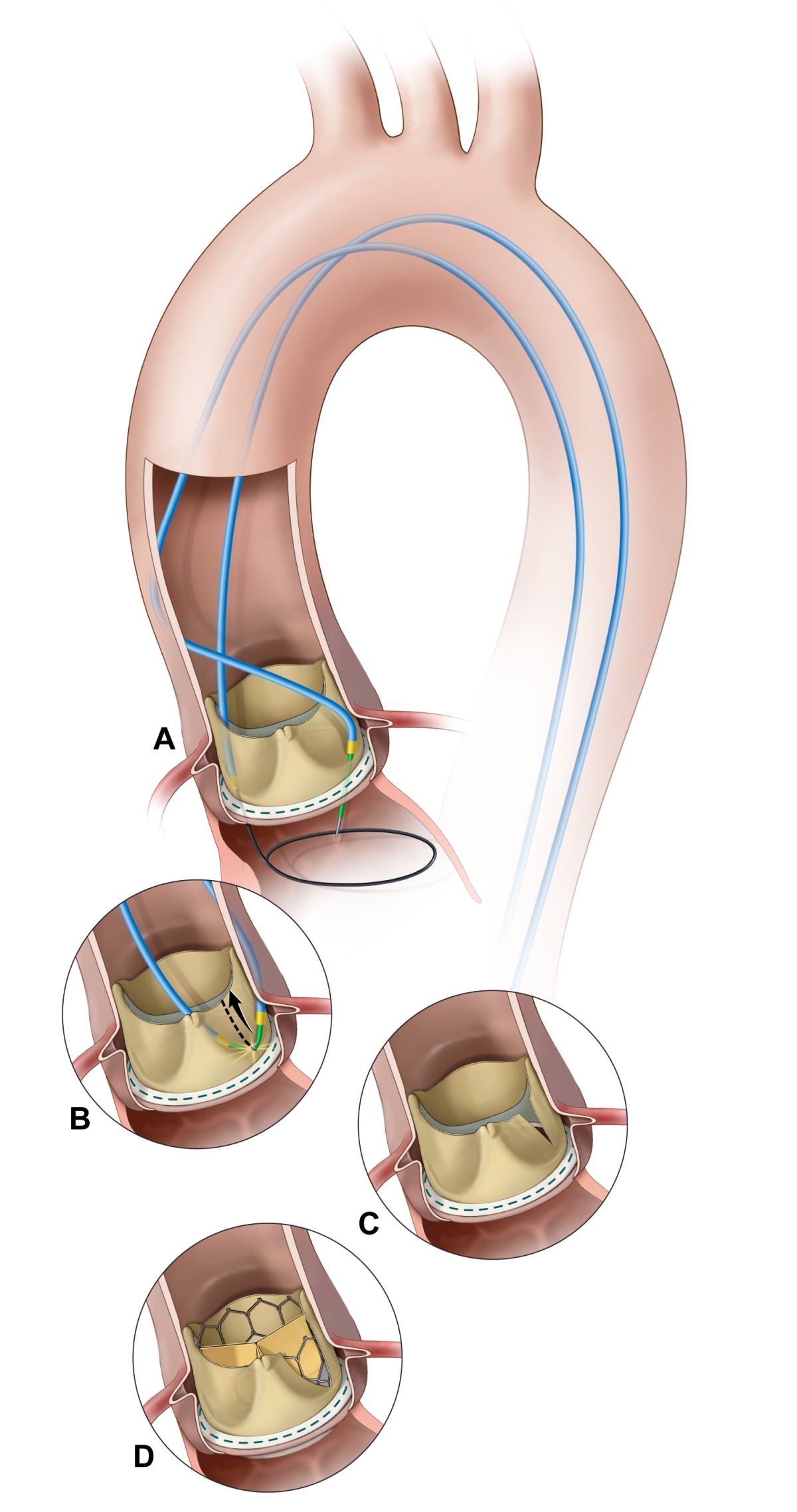 medical-community-finds-ways-to-make-tavr-safer-for-at-risk-patients