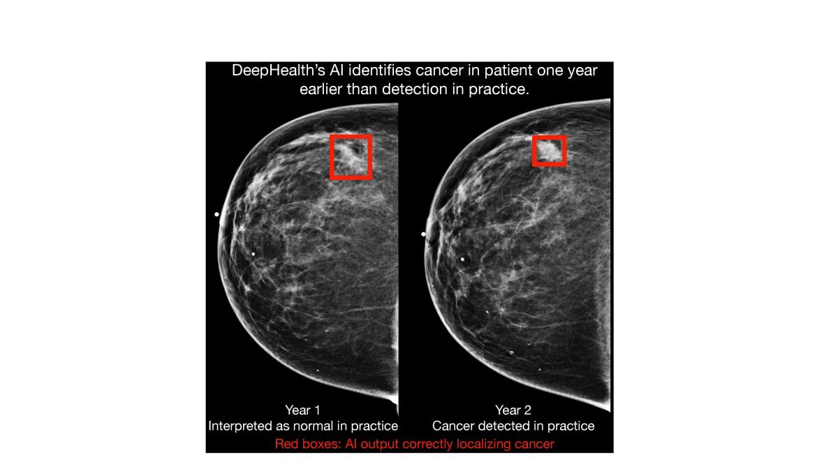 RadNET's DeepHealth AI Facilitates Breast Cancer Detection A Year ...