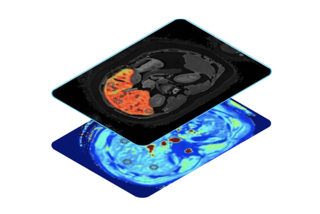 Perspectum software reduces MR costs, biopsies in liver disease diagnosis